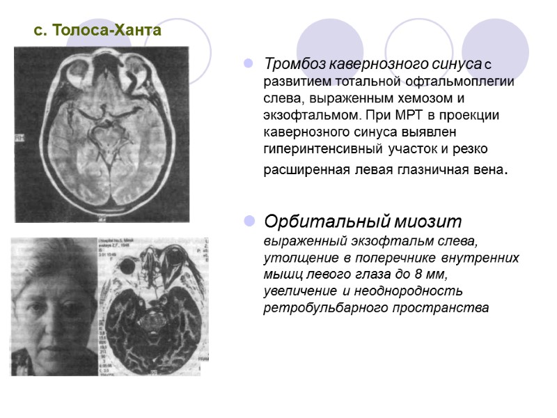 с. Толоса-Ханта Тромбоз кавернозного синуса с развитием тотальной офтальмоплегии слева, выраженным хемозом и экзофтальмом.